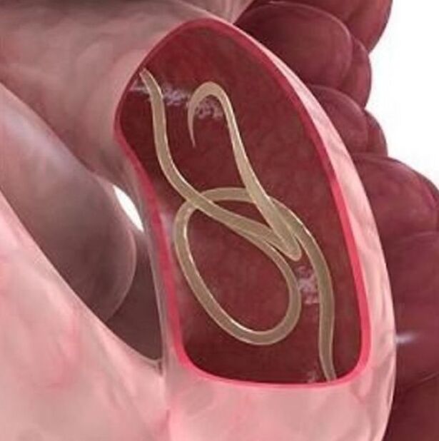 Signs of worms in a man in the gastrointestinal tract