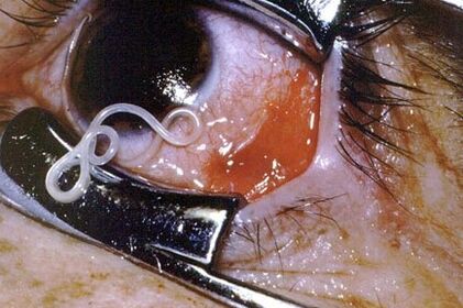 Worms in a person's eyes